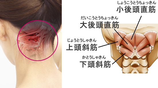 眼精疲労に対する鍼灸治療は主に目周りやこめかみ、頭皮、後頭下筋群、首や肩の筋肉の硬さを解消させて血流を回復させるものです。

とくに「後頭下筋群(こうとうかきんぐん）」は、目の動きに連動しているため必ず施術を行います。
また後頭下筋群が硬くなってしまうと、血管や神経を圧迫してしまい、眼精疲労に留まらず頭痛や首の痛みにもつながってしまう可能性があります。

この後頭下筋群は細かい筋肉の集まりなので、指圧やマッサージではなかなか緩めることが困難な部位です。
このような細かい筋肉を緩めるには鍼灸の効果が抜群です。

鍼灸治療では、小さい筋肉であっても鍼先でピンポイントに刺激することができるため非常に効果を発揮しやすいです。
また、後頭下筋群は極めて刺激に敏感な部位であるため、指圧などの刺激は時に強すぎる場合があり、症状が悪化することも考えられます。
この部位に関しては、鍼灸治療が最適であると当院では考えております。