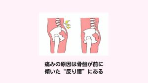 痛みの原因は骨盤が前に傾いた“反り腰”にある産後の方を含めて腰痛や仙骨周囲の痛みが起こりやすい原因に筋肉のアンバランスによる“反り腰”があります。
反り腰は正式名称は“骨盤前傾(こつばんぜんけい)”といいます。

骨盤が前方に過度に傾いた状態により骨盤から上方へ連なる腰椎の湾曲が強まり腰が沿った形になります。
この反り腰になると腰椎が狭まったり仙骨周囲の筋肉の緊張が高まってしまい、腰部や仙骨に痛みが起こりやすくなります。

この反り腰が起こりやすい方の多くは体幹の筋力低下が低下していたり太ももの筋肉が緊張している傾向にあります。