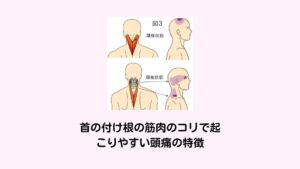 首の付け根の筋肉のコリで起こりやすい頭痛の特徴この首の付け根こりや痛みの原因である板状筋の緊張状態は硬結（筋肉のこり）を起こしやすく「トリガーポイント」と呼ばれる状態になりやすいとされています。

トリガーポイントというのは筋肉のこりが強くなるなることで放散痛（ほうさんつう）と呼ばれる、原因の筋肉以外の部分に痛みが感じる症状を起こす状態をいいます。
板状筋のトリガーポイントによる放散痛が起きる場所はコメカミや頭頂部(頭のてっぺん)になります。

「首の付け根(後頭部あたり)に頭痛のような痛みを感じる」というのはこのトリガーポイントの放散痛によるものです。
これが筋緊張型頭痛と呼ばれるものです。

実は板状筋以外の肩こり頭痛の多くにもトリガーポイントによる放散痛が関わっており、筋緊張型頭痛の全般はこのトリガーポイントを除去し放散痛を完治させたら頭痛が改善できます。