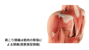 肩こり頭痛は筋肉の緊張による頭痛(筋緊張型頭痛)この猫背による肩こりが長くなると起こるのが頭痛です。
肩こりは首の筋肉の緊張によって起こる症状ですが、この筋肉の緊張が強まると痛みに変わり放散痛(ほうさんつう)という症状を引き起こします。

放散痛は「実際は首が原因であっても少し離れた頭部などに痛みを感じる」というものです。
この離れたところの痛みが「頭痛と感じる」症状になります。 この状態を筋緊張型頭痛といいます。

筋緊張型頭痛の特徴的な痛み方は「締め付けられるような頭痛がする」「温めたり軽いストレッチをすると緩和する」というものがあります。