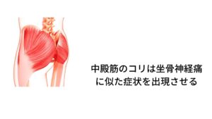 中殿筋のコリは坐骨神経痛に似た症状を出現させるこの“筋硬結(きんこうけつ)”と呼ばれる筋肉のコリは痛みとしびれを起こしますが、発生する箇所によっては坐骨神経痛に似た症状を出現させることがあります。
坐骨神経痛は梨状筋というお尻の筋肉が坐骨神経を圧迫することでお尻の痛みと太もも、ふくらはぎとしびれを起こします。

このしびれに似た症状を出すのが中殿筋のコリ(トリガーポイント)です。
中殿筋は股関節周囲に付いている筋肉であり、梨状筋とも近い位置にあります。

この中殿筋のコリが強くなるとお尻に痛みとしびれが出現します。
整形外科では度々この中殿筋のコリによる痛みとしびれを「坐骨神経痛」と診断することがあるくらい起こりやすい筋肉のコリ(トリガーポイント)になります。※2