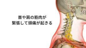 枕に対して頭の位置が悪いと首や肩の筋肉が緊張して頭痛が起きる頭痛が起きやすい体質で「朝起きた時から頭痛がする」という方がいます。
この場合、頭痛を引き起こしている原因に首や肩の筋肉の緊張が考えられます。

多くの方は「横になって眠っているのになぜ首や肩がこるのか」と疑問に思うかもしれませんが、実は枕に対して頭の位置が悪いと首や肩の筋肉が緊張することがあります。
就寝中は無意識であるため眠ってしまえばそこまで不快に思わないで眠れています。

しかし、身体的には枕と頭が合わないために首と肩に長時間ストレスがかかっており頭痛が起きやすい環境といえます。
この条件になると起床時に頭痛や寝違えが発生します。

この筋肉の緊張による頭痛を筋緊張型頭痛と呼びます。※2