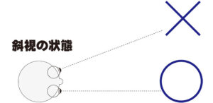 片側の目の視線が逸れてしまうと斜視が起こる斜視とは片眼は目標のほうに正しく向いているが、もう一方の眼が内側や外側、上下などに視線が逸れている状態の事を指します。

斜視は眼のトラブルの中では外見的特徴として比較的わかりやすい状態です。
タレントさんでも時折いらっしゃいますので、どのような状態かはイメージしやすいかと思います。

この斜視の種類は斜視のある側の目がそれぞれ、

・内側に向くものを内斜視
・外側を向くものを外斜視
・上や下を向くものを上下斜視

などといい、その他に恒常的な斜視であるか、時々起こる間欠性の斜視か、先天的または後天的な斜視か、などの条件で病名は細かく分類されています。

斜視がある方の目の状態をご説明します。(今回は左目が外斜視の人の場合)

目の前の〇に焦点を合わせようとします。
右目は真っ直ぐ捉えていますが、左目は○に合わせることができずに×を捉えてしまっています。

このような状態では脳に「右目の〇と左目の×」の映像が送られてしまいます。

映像が重なってしまうと非常に生活しにくくなるため、脳は斜視である左目からの映像を「抑制」という脳機能を使って見ないことにしようと調節します。
これによって映像が重なることのない映像として脳が処理して物を見ることができるわけですが、両眼視機能は失われ立体視ができない片眼視の状態になってしまうのです。

これにより片眼は抑制による映像の遮断が続いてしまうため、視力が低下する傾向があり、弱視となる可能性もあります。
これが俗に言うガチャ目と呼ばれるものです。