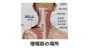 肩こりが一番起こりやすい僧帽筋の場所この僧帽筋(そうぼうきん)がこると肩こりだけでなく頭痛を引き起こすことが多々あります。

表層にある幅広い形状の筋肉ですので、少々の張り程度ならマッサージでも対応可能ですが、肩こりが強くなるとこりが広範囲に発達してコブの様に盛り上がったり、石のようにカチカチに固くなってしまっている場合には、マッサージだけではとても完治させることができません。

この様な場合は鍼灸治療がとても有効です。
なぜ鍼灸治療が有効かというと、上記の様な状態の場合はもはや僧帽筋だけの肩こり症状ではなくなっているからです。

上の図の右半分は僧帽筋を取り除いたもので、一段階深いところにある筋肉群が見えています。
こり症状はすでにこれらの筋群にも及んでいるため、鍼じゃないとアプローチできない状態です。

この僧帽筋の下には、肩こりの原因として重要な筋肉が隠されています。
それが肩甲挙筋と呼ばれるインナーマッスルです。