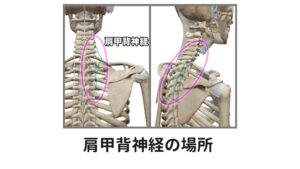 肩甲背神経が圧迫されると首こりが起こるまた中斜角筋と後斜角筋の間から背中に走る肩甲背神経も出ているので、この二つの筋肉のコリで圧迫されると首だけでなく肩甲骨の内側あたりにも筋肉がこった痛みが出ます。

ここの場所も首こりの見逃すわけにいかない治療ポイントです。

そして次は胸鎖乳突筋(きょうさにゅうとつきん)です。
かなりこの重要な筋肉であり、頑固な頭痛や自律神経失調症、慢性的な疲労感など、多くの症状の原因になるところでもあります。