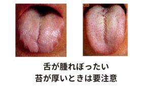 舌が腫れぼったい、苔が厚いときは要注意水分代謝が停滞する原因には湿気や気圧など気候変動だけでなく、冷え、疲れ、過食、甘いものや油濃いもの食べ過ぎ、内臓機能（特に 肺・胃腸・腎）の低下など様々です。

東洋医学では舌診(ぜっしん)と呼ばれる、舌を診る検査をします。
特徴的な舌の状態は腫れぼったく大きかったり、苔が厚いといったものが診られます。

この舌の状態の場合は余分な水分が停滞サインになります。
このタイプはよく「水 2リットル健康法」などは余計な水分補給を行って体調が悪化しているケースが多々あります。

この場合は水分補給は適度に抑えて、身体の水はけをよくすることが先決です。