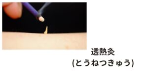 お灸のやり方私がお伝えするお灸は、「透熱灸(とうねつきゅう)」と「台座灸(だいざきゅう)」です。
透熱灸は、もぐさを「米粒」または「半米粒」ほどに捻って行なうお灸です。

昔は、家庭でもやっていたようです。
このお灸を、1日3壮から始めます。

慣れてきたら5壮・7壮と増やします。
効果のあるお灸ですが、作るのが難しい事が難点です。