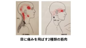 目に痛みを飛ばす2種類の筋肉上の図はトリガーポイント疼痛パターン（エンタプライズ出版）から引用したものです。

【①僧帽筋(そうぼうきん)】
肩こりの原因では代表的な筋肉です。
【②頚板状筋(けいばんじょうきん)】
首の後ろ側にある筋肉です。


首を反らすとこの2つの筋肉が硬くなりどちらも目に痛みを飛ばすことが示されています。