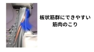 板状筋群にできやすい筋肉のこり両側の頚板状筋(けいばんじょうきん)が同時に作用すると首を後ろに倒します。
片側だけだと同じ側に頚部を回旋させる働きをします。

頚板状筋はそれ以外にも姿勢の安定に大きく関わっています。
先ほど解説した右利きの人の首が右側に倒れやすくなって負担となるのはこの筋肉です。

特に「頭が体幹に対して前に突き出る様な姿勢(いわゆる猫背姿勢)」や「うつ伏せ寝でいつも顔が右向きになって寝ている」などがあると右の板状筋にこりができてしまいます。このこりがトリガーポイントと呼ばれる状態になります。