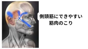 側頭筋にできやすい筋肉のこり側頭筋は咬筋、内側翼突筋　外側翼突筋などと一緒に物を噛むときに機能します。
下の顎を上に挙げる作用を持っている筋肉のため硬い食べ物を食べたときに「こめかみ」が痛くなるのはこの側頭筋が疲れている状態です。

右利きの人は頚部が右側屈しやすいと噛むのも右側になる傾向があります。
この偏った右側の側頭筋の緊張が強くなるとトリガーポイントを形成し、頭痛が起きます。

また集中している時などに奥歯をギュッと噛んで食いしばる癖があると、それだけでも右側に頭痛が起こる事があります。