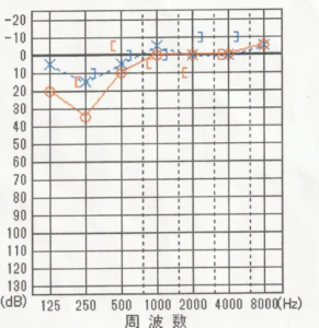【再発から2回目の問診】
1回目の鍼灸治療後から全体的に改善する。
右耳250Hzが35dB は残存している。
自覚症状は「音が反響して聴こえるのは減少した、低音の耳鳴りも減った。」との変化がある。
症状を説明するときに「音の種類によって響くわけではない。時間帯によって響く。規則性はなく疲れると響く。」とのこと。