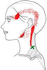 この上部線維は、肩こりだけでなく頭痛も引き起こします。
側頭部からこめかみにかけての赤いマーカー部分に頭痛が起こります。