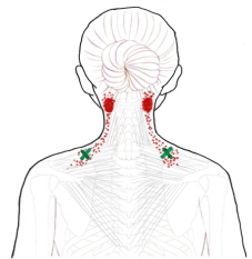 【僧帽筋の上部線維の肩こり】
赤いマーカーの部分で起こる
＜痛みの特徴＞
・後頭部に痛みが起こる
・首の後ろのこりや痛み