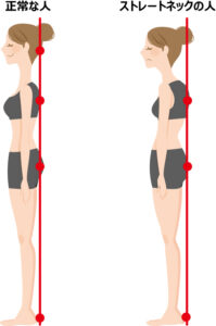 なぜ姿勢の悪さが頭痛の原因となるのでしょうか。
それは壁に背中を付けて立った時の頭の位置でわかります。

上の図のようにストレートネックや猫背などの姿勢の癖があると頭が前方に突き出るかたちになります。
頭が前に落ちないように、首の後ろの筋肉が緊張し支えるかたちをとるようになります。

そのため頭部に関わる筋肉は過剰に緊張を強いられます。
この肩や首の筋肉の緊張が頭痛を起こします。

「姿勢を正す、伸ばすことで頭痛が改善される」というのは、ストレートネックや猫背が改善できるからになります。