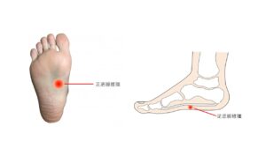 足底繊維腫は土踏まずの部分に多くみられる良性の腫瘍です。
歩くときに痛みが起こるため足底腱膜炎と同じ症状です。
この足底繊維腫は土踏まずの中央部分や踵の近くに起こります。
おおよそ約1～2ｃｍのこぶを触れることができるのが特徴です。

原因には頻繁に足底腱膜への小さな刺激や、感染などが原因とされています。