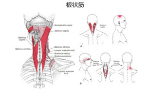 背骨から側頭骨（頭の横の骨）にかけてつく筋肉です。
前述した半棘筋と同じ働きをもっているため、頭が前に出ている姿勢が続いたときに負担がかかる筋肉です。
この板状筋は硬くなる箇所によっては頭頂部(頭のてっぺん)や目の奥、肩の付け根に痛みを起こすことがあります。