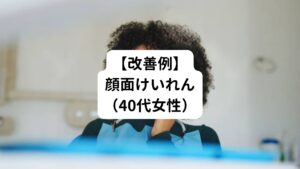 顔面けいれん（40代女性）
【現病歴】
来院される3週間程前から頬がピクピクするようになり、ほかの鍼灸院で鍼治療を受けたが全く改善しなかったため当院に来院する。
もともと疲労がとれにくく、声もか細い状態である。
日常的に寝つきも悪いため睡眠導入剤を常用している。
顔面けいれんだけでなく後頭部や側頭部に痛みあるため早く症状改善されたいと話していた。