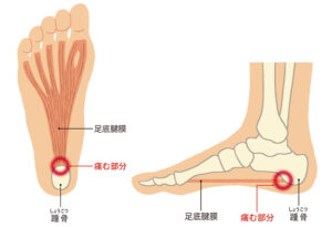 足裏の痛みで最も起こりやすい疾患は足底腱膜炎(足底筋膜炎)です。

足底の筋肉は「足底腱膜」という膜に包まれています。
この足底腱膜が炎症を起こしたり、硬くなって柔軟性を失った状態を足底腱膜炎といいます。

主に歩く、走る、足を地面に着地するときに足底腱膜が強く引きのばされることで足裏に痛みが起こります。