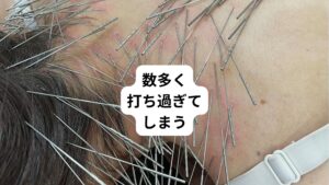 例えば「肩や首が凝る」という症状の方に良かれと思って首や肩まわりに鍼を必要以上に数多く鍼を刺したとします。
この鍼刺激に対して丈夫な方は平気ですが、繊細な方や体力が弱っている方などは以下のような不調が起こります。
・ふらつき
・貧血
・のぼせ
・頭痛
これは首や肩だけを刺激しすぎたことによって起こる揉み返しのような「鍼当たり」と呼ばれる生体反応です。
このように1か所に集中して刺しすぎるとこのような体調不良が起こります。
ルート鍼治療の場合、このような生体反応をスピリチュアルなものとして考えますが、そうではありません。
解剖生理学(科学的)としてもこのような生体反応は体にとって良くない反応として考えます。
無理矢理に鍼あたりを起こすことは症状悪化につながるため危険です。
