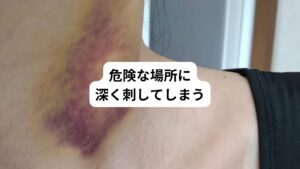 鍼灸治療では深く刺しすぎると最悪内臓や器官を傷つけてしまう恐れがあります。
一番鍼灸治療中の事故として多いのが気胸です。
気胸は肺に穴を開けてしまう状態をさします。
とくに胸まわりや背中、肩や首など、肺の近くに深く鍼を打つと事故につながるリスクが大きくなります。
さらに、奥には大切な血管や神経が通っている場所もあるため、間違って傷つけてしまうと内出血だけでなく神経損傷による痺れが起こることがあります。