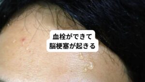 体温が高温になると血中の水分が不足し血栓ができやすくなり、脳梗塞が起きやすくなります。
血栓ができやすくなる理由は以下の2つにあります。
・タンパク質が固まる
・水分不足になり血が固まりやすくなる