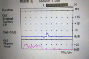 そしてこちらが耳管狭窄症(耳管機能の異常)の波形です。
正常の波形に比べると山の高さが低くなっています。
これは耳管が開きにくいために鼻から入れた音が耳の方へ届きにくくなっている事をさします。