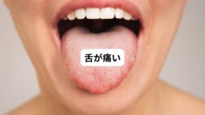 まずは舌が痛くなる原因について解説します。
以下の通りです。