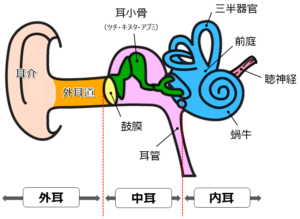 耳の奥（内耳）には「前庭」と呼ばれる部位があり、そこに平衡感覚を司る「三半規管」という装置が存在します＜図2＞。三半規管は3つの輪のような管で構成され、内部は「リンパ液」という液体で満たされています。頭を左右に振ったり、首を前後に動かしたりすると、この液体が慣性で反対方向に動きます。内耳はこの液体の流れを感知して「頭がどの方向に動いたか」を脳へ伝達します。この仕組みにより、私たちは目をつぶっていても自分の姿勢を正確に把握できるのです。では、片方の内耳に異常が起きた場合はどうなるでしょうか。例えば、右の三半規管に「耳石（じせき）」というゴミのような固形物が入り込んだとします。頭を動かした際、正常な左側は「頭が動いた」と正しく伝えます。しかし、右側はゴミが液体の動きを妨げる、あるいは異常な刺激を与えるため、「動いていない」または「全く別の動きをした」という誤った情報を送ります。脳（平衡中枢）は左右の耳からの情報の矛盾を処理しきれず混乱し、結果として激しい「回転性めまい」を引き起こします。この情報の食い違いは「頭を動かしている最中」だけに生じるのが特徴です。頭の動きを止め、管内の液体が静止すれば情報の矛盾は解消され、めまいも治まります。このように、特定の頭位で数秒から数分だけ起こる症状が、耳性めまいの代表格である「良性発作性頭位めまい症（BPPV）」の正体です。この原因を正しく理解することが、症状の改善に向けた第一歩となります。